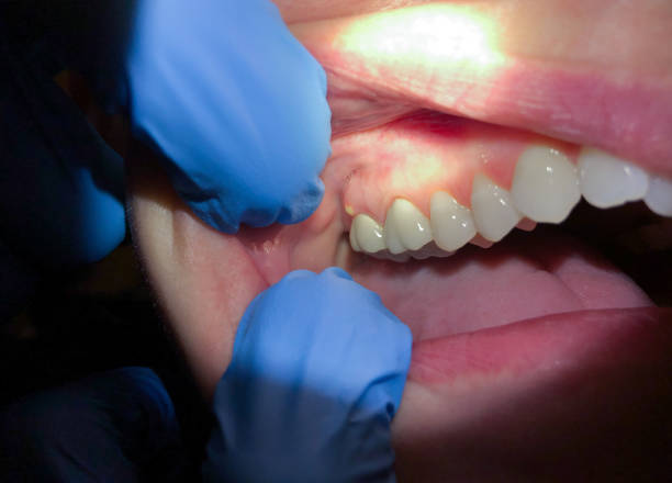 Best Emergency Treatment for Dental Infections or Abscesses in Pleasant View, TN