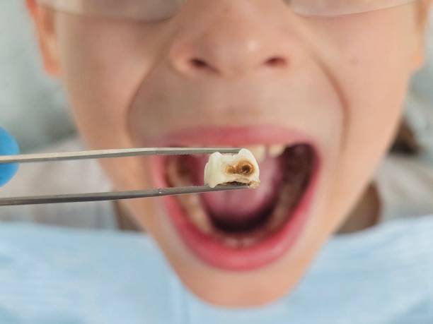 Best Emergency Tooth Extraction in Pleasant View, TN